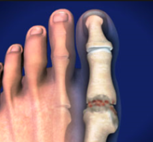 Hammertoe Treatment Sydney  Foot Deformities Treatment Sydney