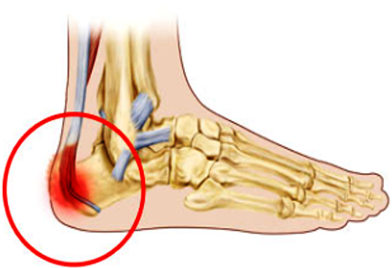 Growing pains achilles on sale tendon