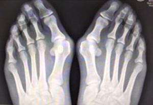 hallux3