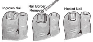 Ingrown Nail Surgery - Sydney Foot Clinic