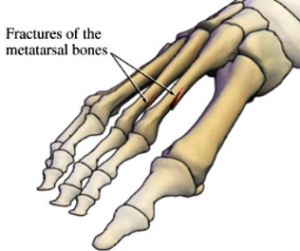 stressfracture1