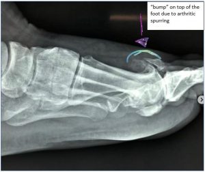 Is that bump on your toe really a bunion? - Sydney Foot Clinic