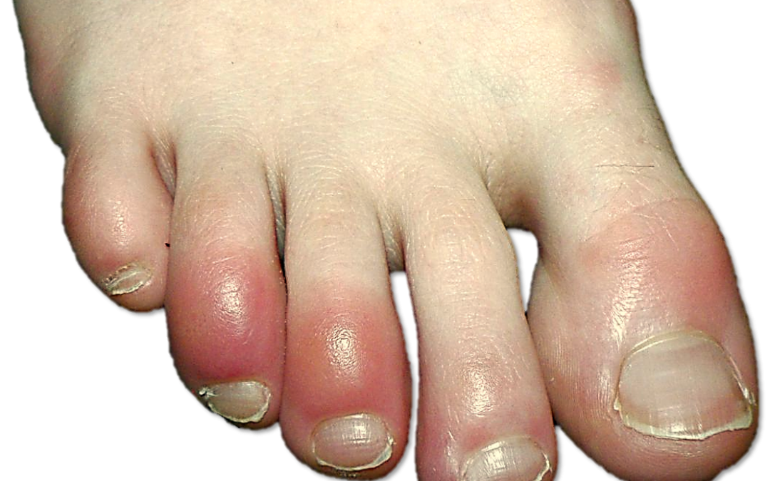 red-spots-on-hand-and-feet-pictures-photos