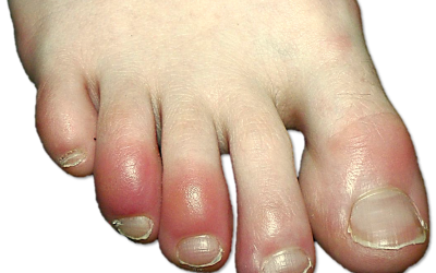 Sore, red toes in winter? Chilblains