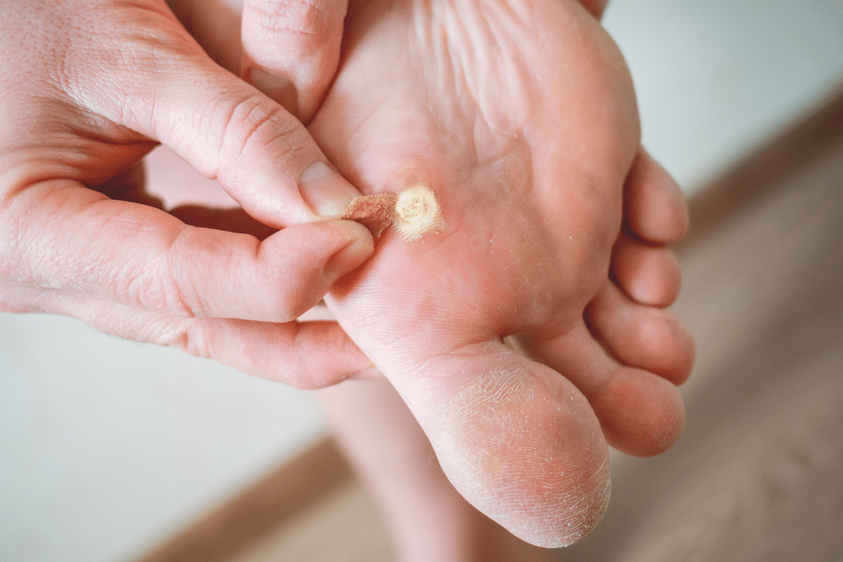 plantar wart Sydney Foot Clinic