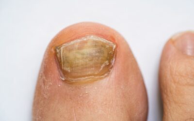 Fungal Nail Infections: Sneaky Problems Hiding in Your Toenails