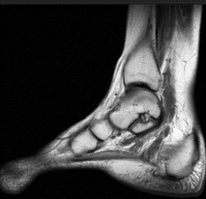 Tarsal Tunnel Syndrome