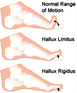 Hallux Limitus
