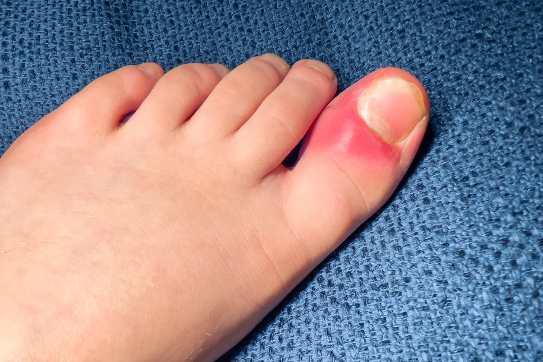Advanced Ingrown Nail Surgery