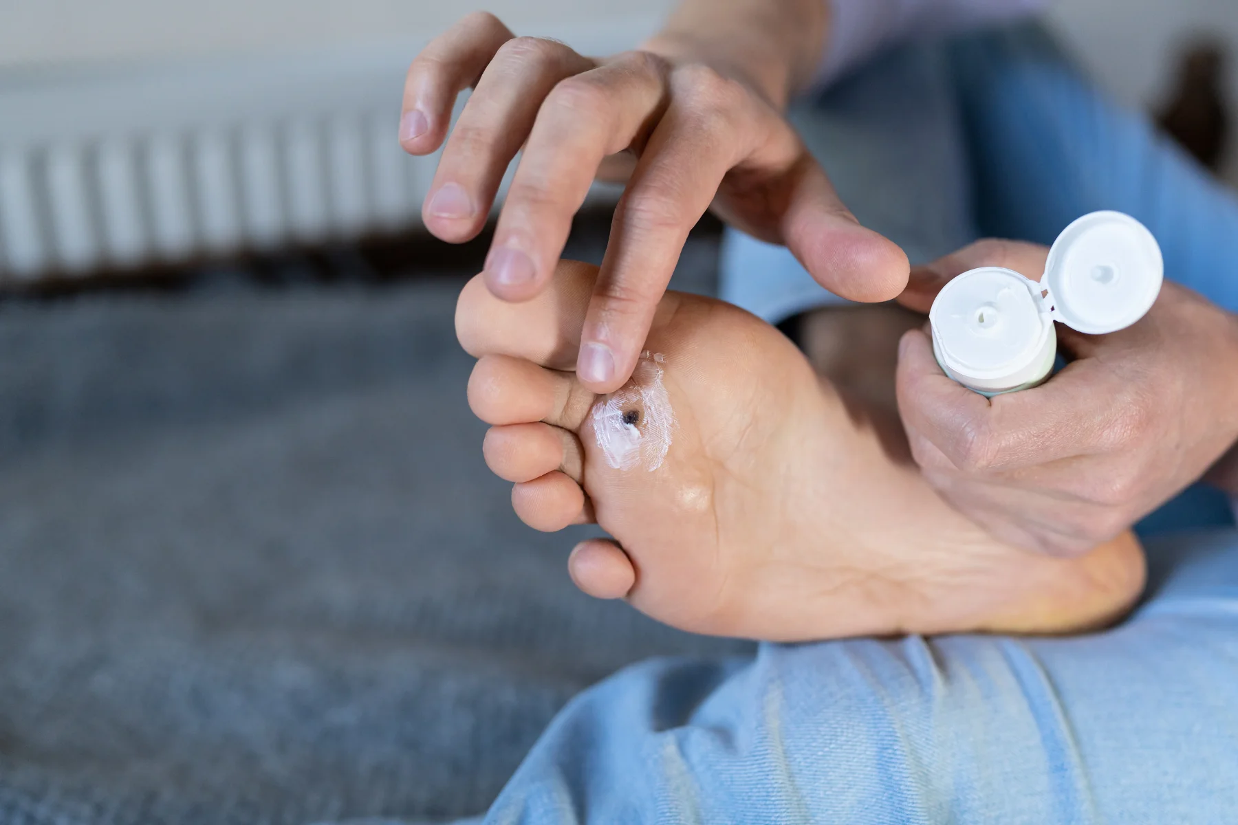 Plantar Wart Therapy