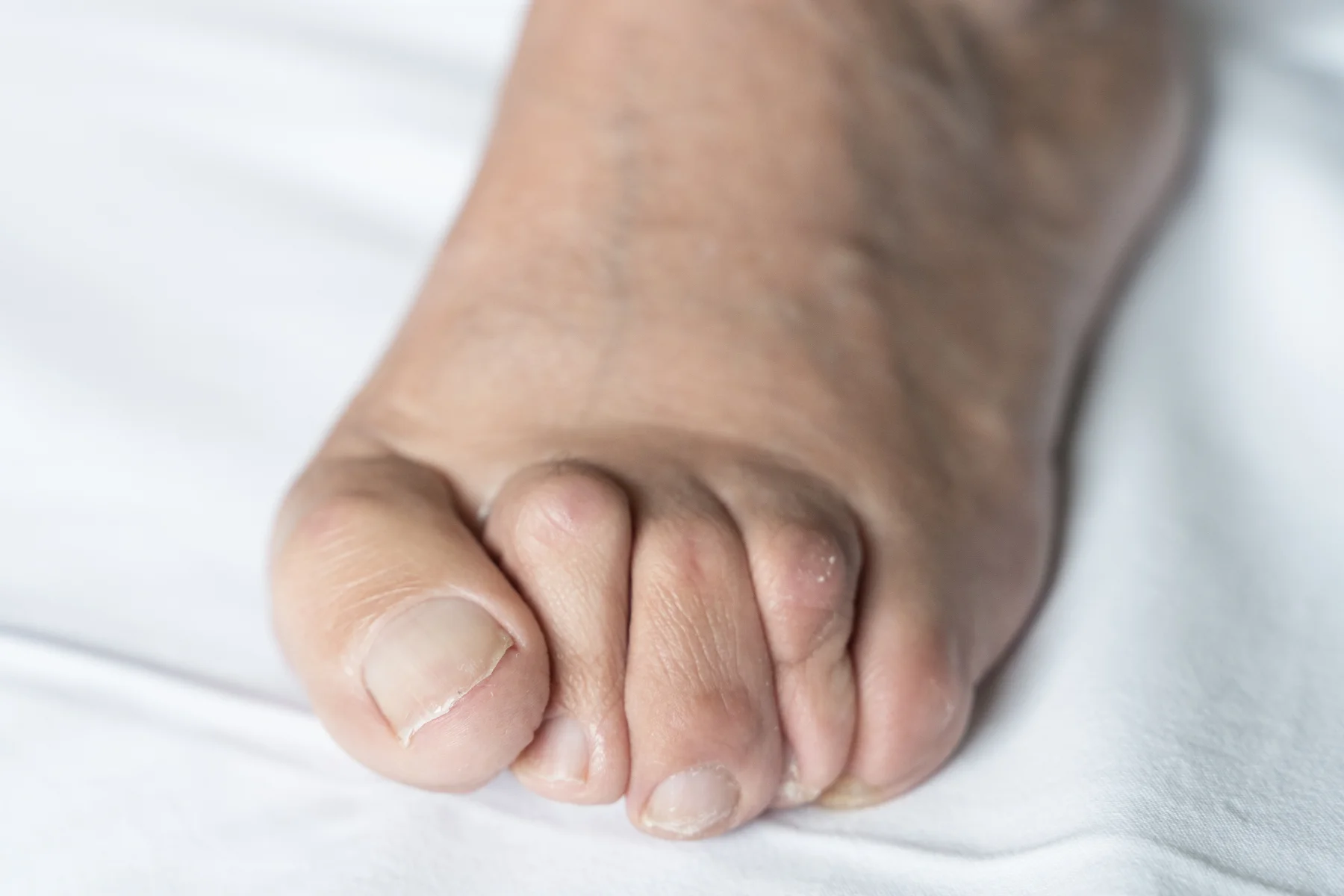 Hammer Toes