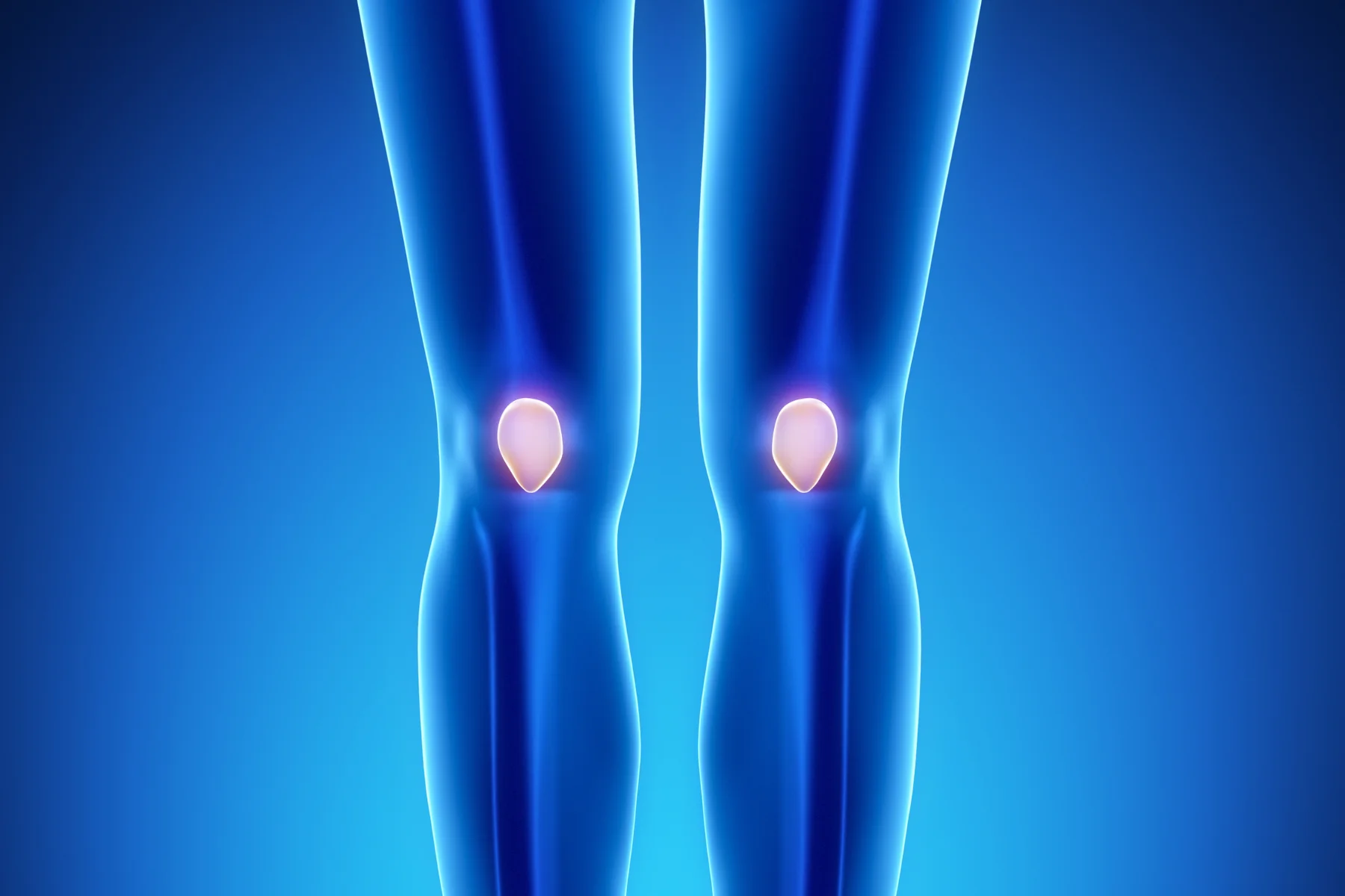 Patella femoral pain syndrome (Runner’s Knee)