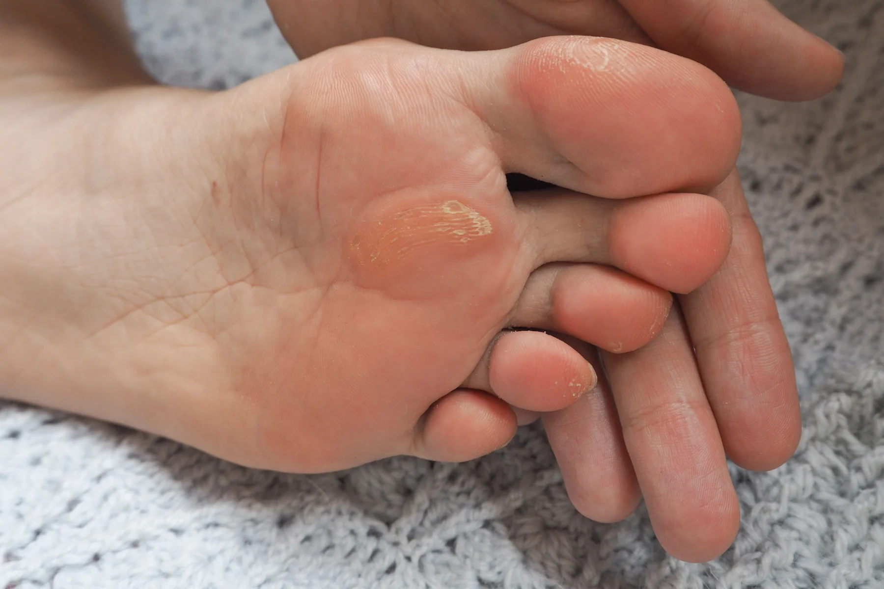 Calluses