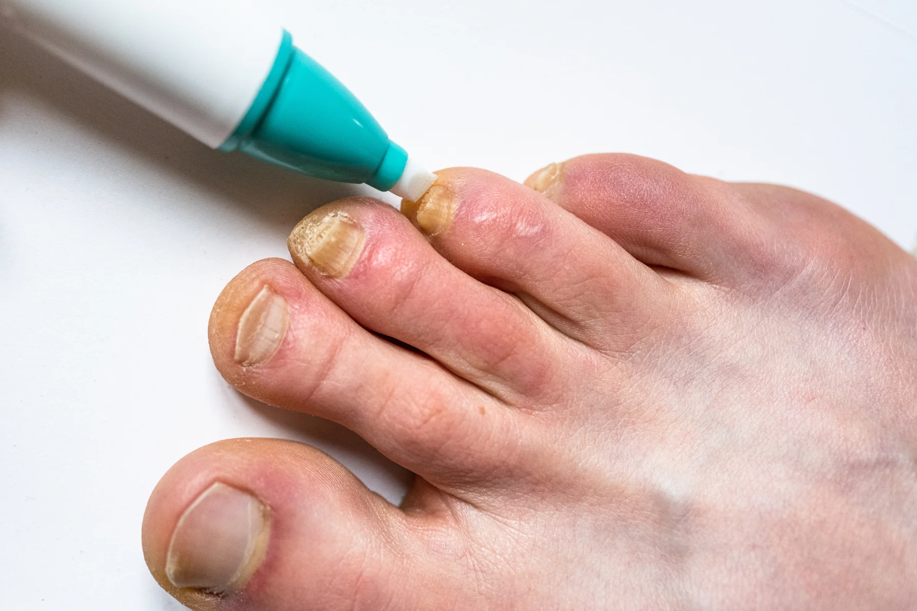 Professional Care for Fungal Nails
