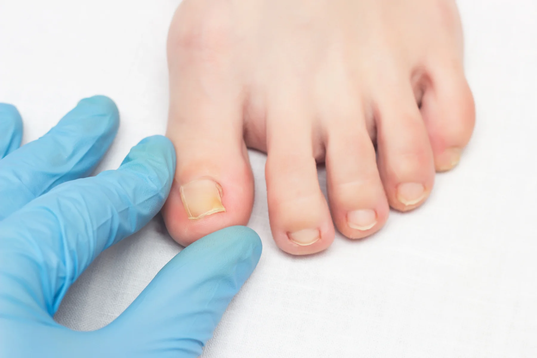 Ingrown Toenails in Sydney Foot Clinic