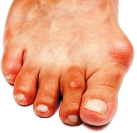 Hallux Abducto Valgo